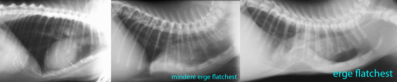 Een normale borstholte en een minder erge en een erge flatchest